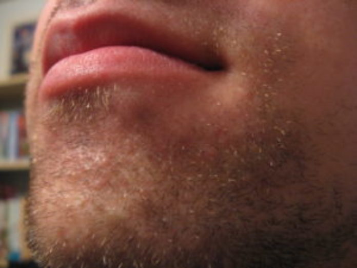 beard-300x225