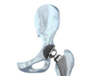 Orthopedic industry could see negative impacts from tariff on foreign steel and aluminum