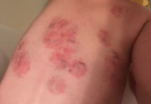 Warsaw babysitter facing charges after two kids were bitten while in her care