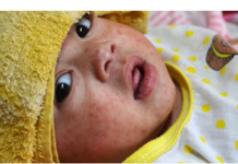 State health department IDs first measles case in five years