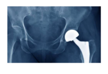 Manufacturing showcase will spotlight region and role of orthopedic capital