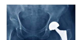 Manufacturing showcase will spotlight region and role of orthopedic capital