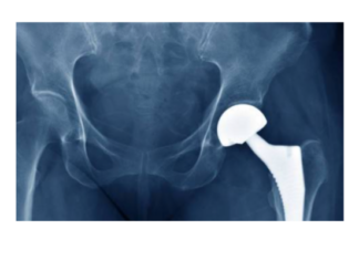 Manufacturing showcase will spotlight region and role of orthopedic capital