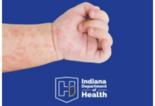 State reports first Measles case in Kosciusko County
