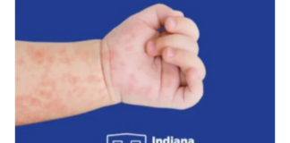 State reports first Measles case in Kosciusko County
