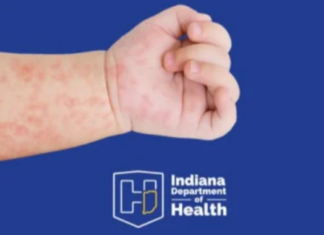 State reports first Measles case in Kosciusko County