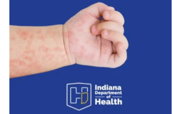 1029 MEASLES